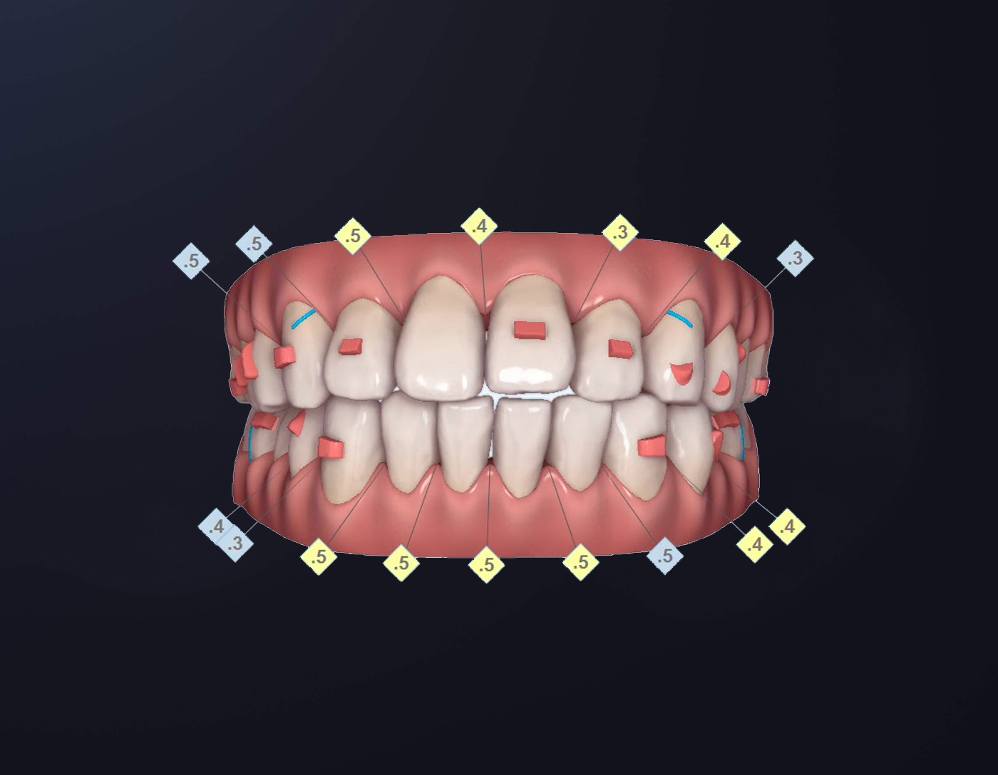 Niềng răng toàn hàm - Nha Khoa Blossom - Nha khoa thẩm mỹ hàng đầu đến ...