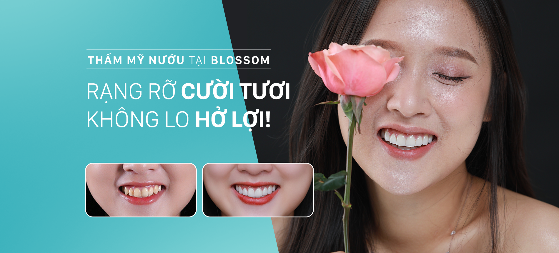 Điều trị hở lợi (thẩm mỹ nướu) blossom clinic Dán sứ Blossom LamiFilm không mài Trồng răng Implant Niềng răng Invisalign