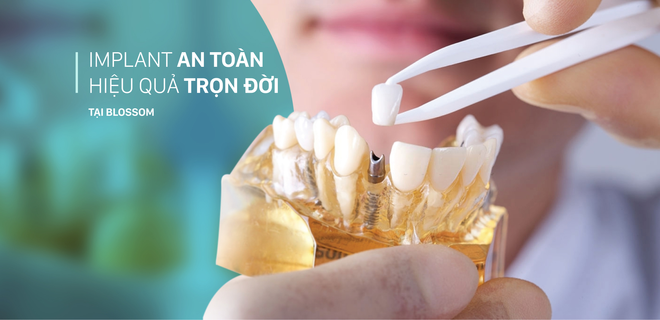Implant an toàn là gì? blossom clinic Dán sứ Blossom LamiFilm không mài Trồng răng Implant Niềng răng Invisalign