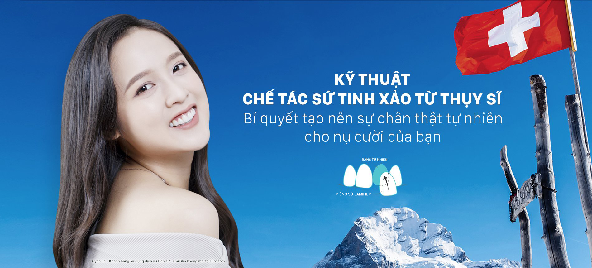 Kỹ thuật không mài răng độc đáo từ Thụy Sĩ blossom clinic Dán sứ Blossom LamiFilm không mài Trồng răng Implant Niềng răng Invisalign