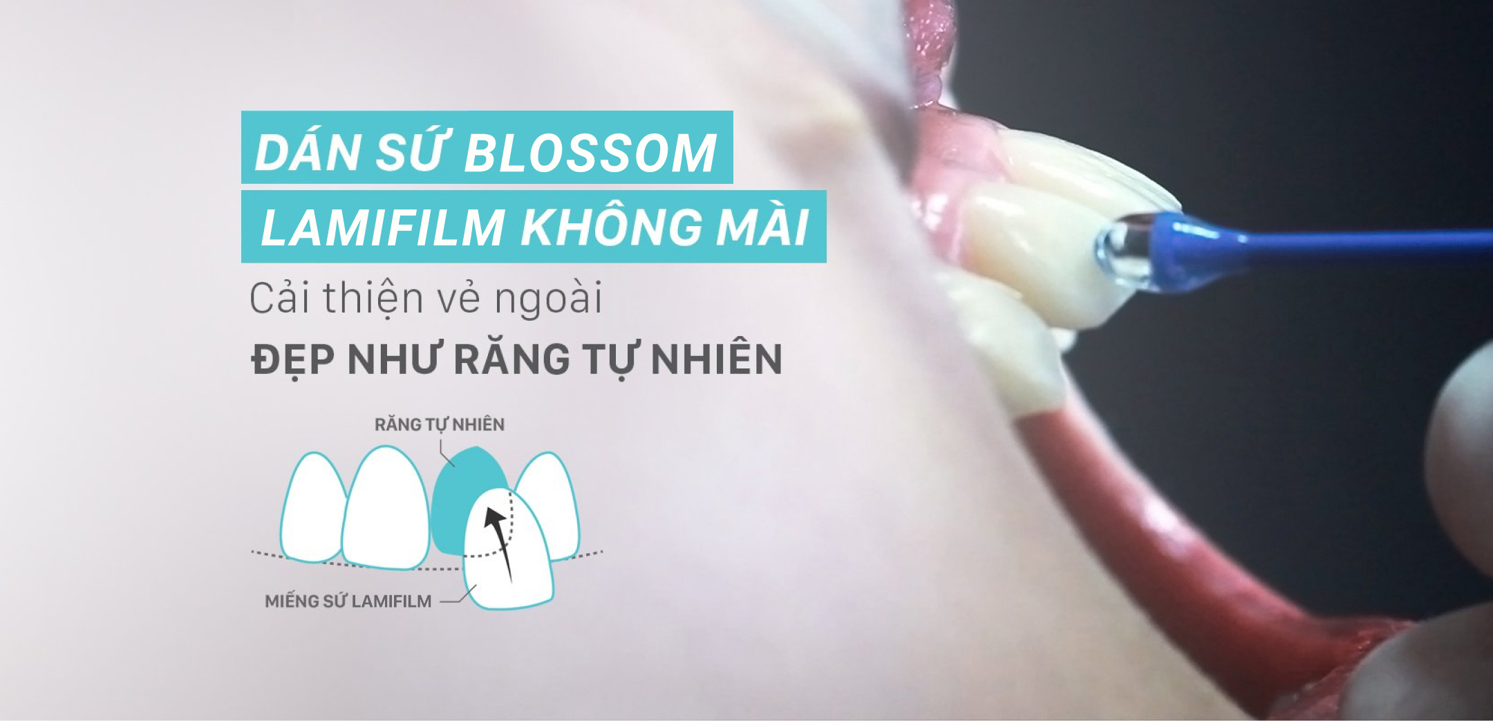 Dán sứ Blossom LamiFilm không mài là gì? blossom clinic Dán sứ Blossom LamiFilm không mài Trồng răng Implant Niềng răng Invisalign