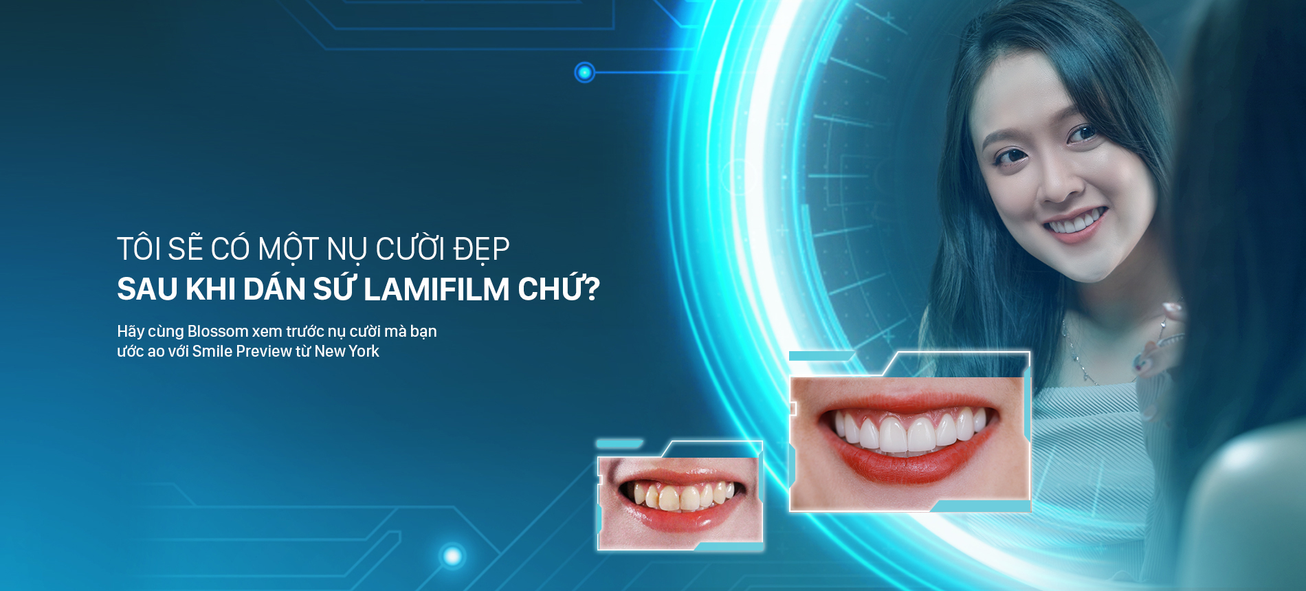 Kỹ thuật Smile Preview – Xem trước nụ cười blossom clinic Dán sứ Blossom LamiFilm không mài Trồng răng Implant Niềng răng Invisalign