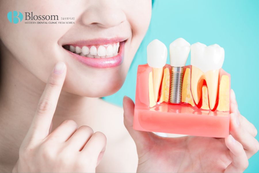 Cấy ghép Implant giúp bảo vệ răng thật một cách tối ưu