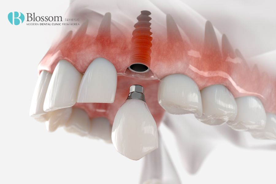 Cấy ghép Implant là kỹ thuật thay thế chiếc răng đã mất bằng răng giả và cắm trụ Implant