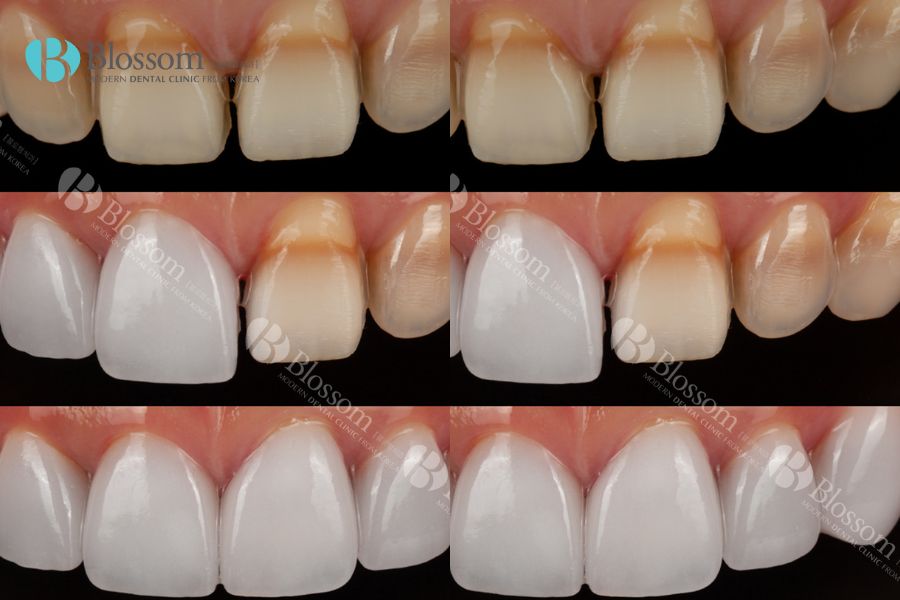 Dán phủ răng sứ có tác dụng hạn chế quá trình mài răng gốc