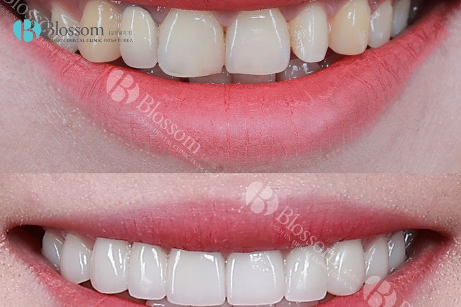 Dán phủ sứ răng là phương pháp hiện đại, không gây đau đớn hay làm tổn thương tủy răng