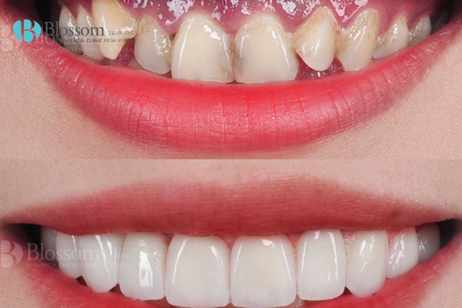 Dán răng sứ không mài răng được ưa chuộng bởi bảo tồn được cấu trúc của răng thật