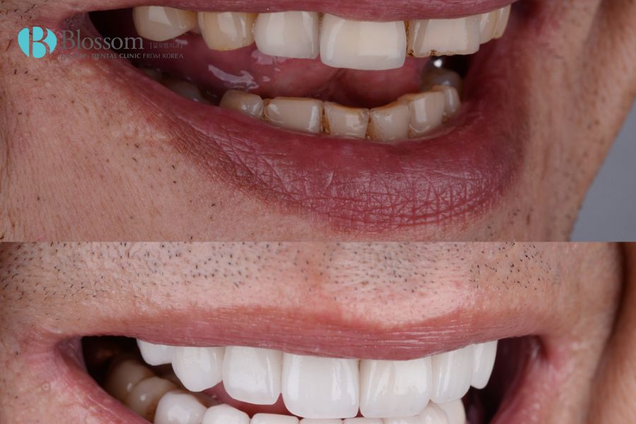 Dán răng sứ Laminate được ưa chuộng bởi khả năng bảo tồn tối đa cho răng thật