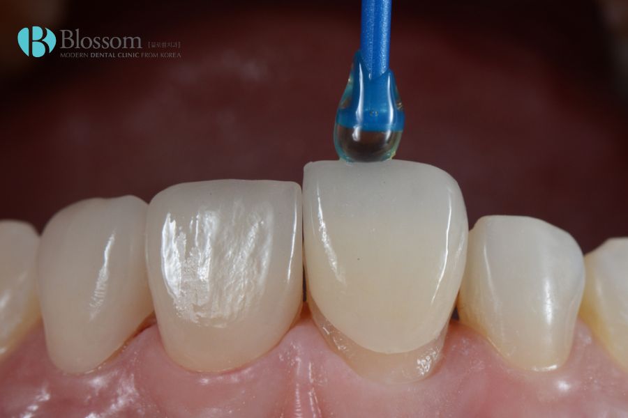Dán răng sứ Laminate với quy trình rõ ràng và an toàn