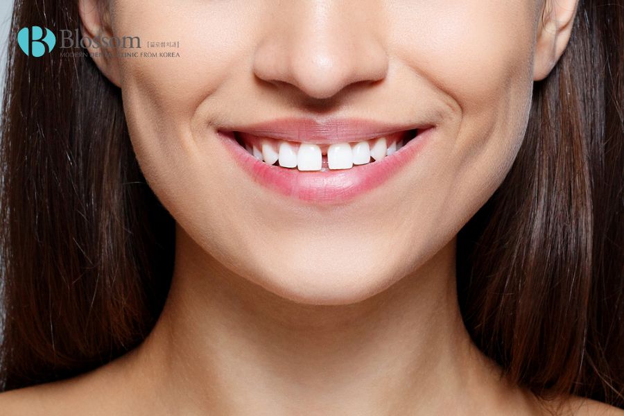 Dán sứ cho 2 răng cửa giúp cải thiện khuyết điểm răng thưa hiệu quả
