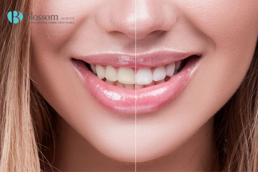 Dán sứ cho 2 răng cửa tùy thuộc vào nhiều yếu tố, dao động từ 6 - 12 triệu đồng/răng