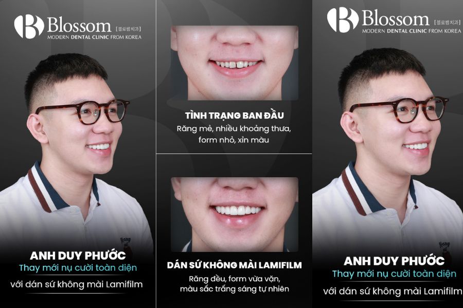 Dán sứ răng không mài răng chất lượng tại Nha Khoa Blossom