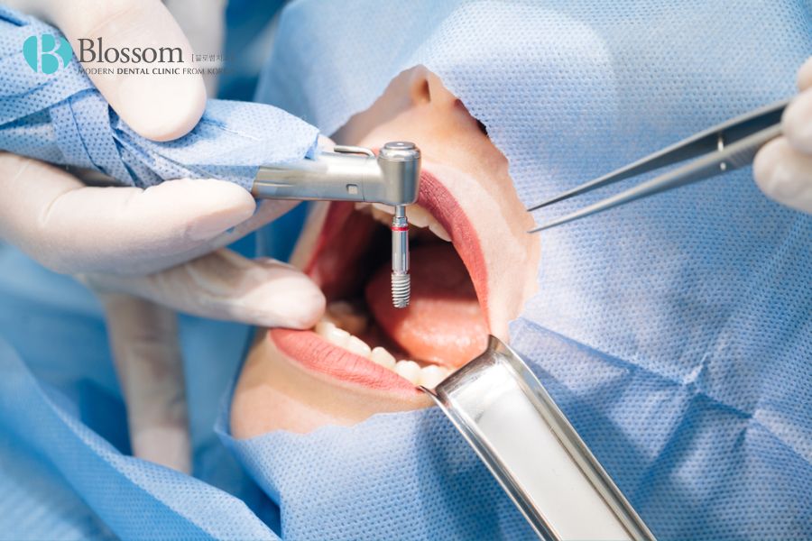 Đặt trụ Implant thường được các bác sĩ tiến hành trong thời gian nhanh chóng