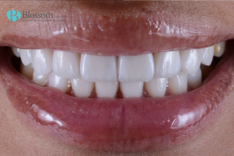 Giá dán răng sứ Laminate phụ thuộc vào chất liệu sứ, trang thiết bị,...