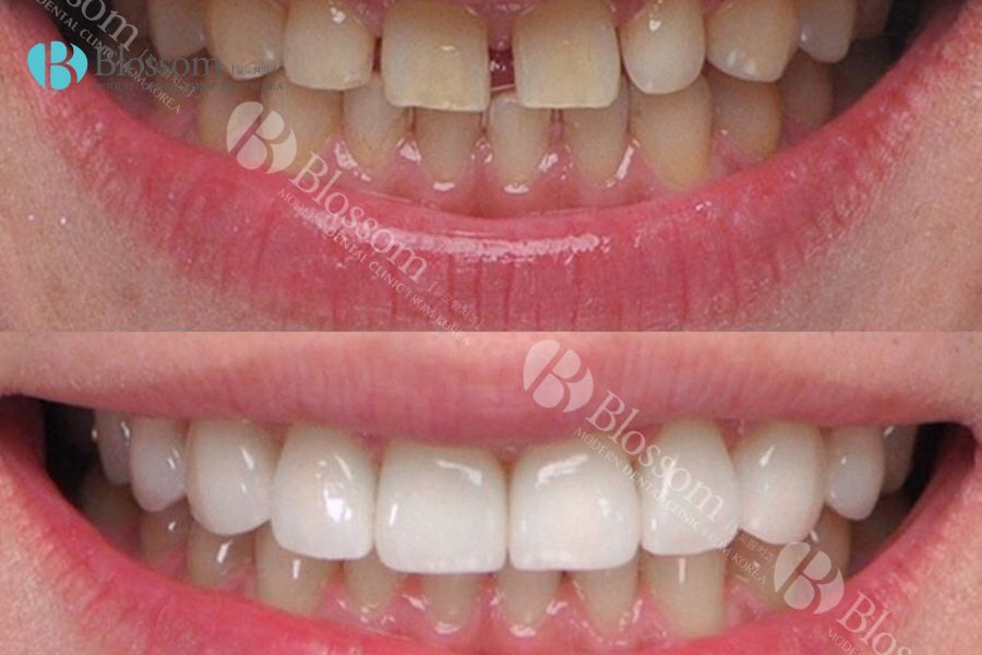 Hàm răng trở nên trắng sáng tự nhiên sau khi dán răng sứ Lamifilm thẩm mỹ