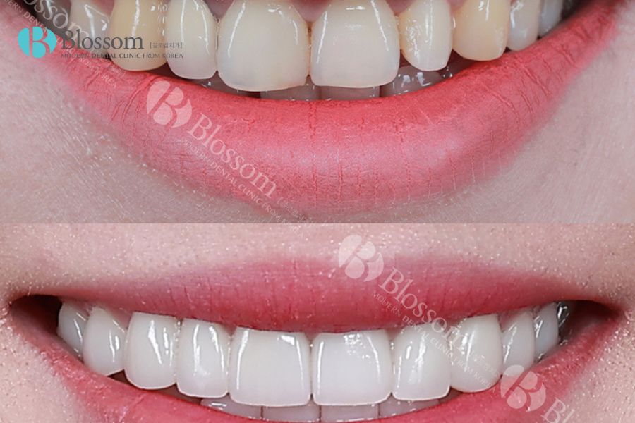 Kỹ thuật dán răng sứ Lamifilm uy tín, an toàn tại Nha Khoa Blossom