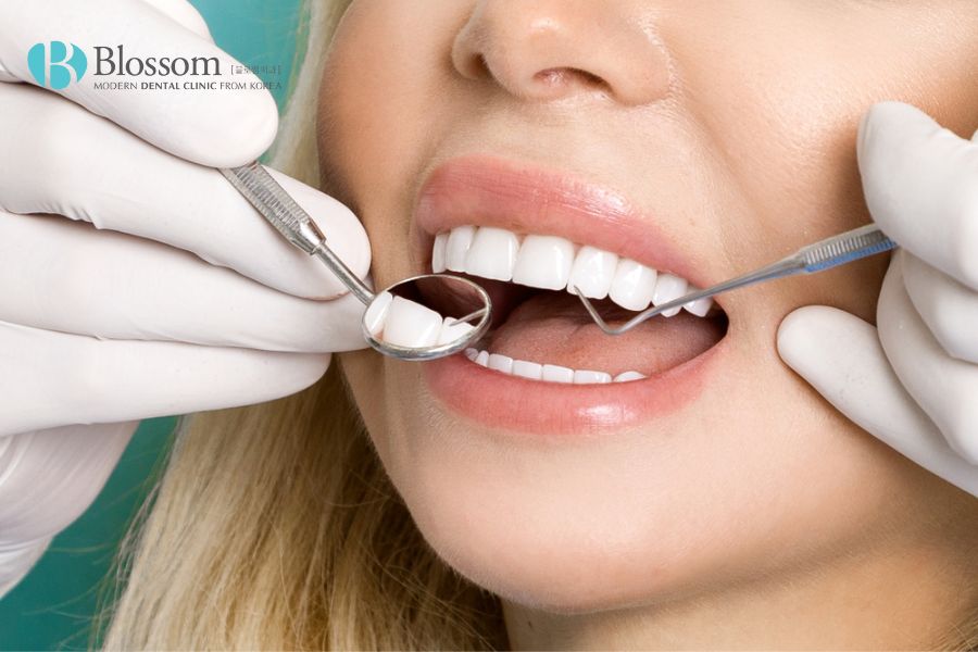 Kỹ thuật dán sứ không mài răng diễn ra trong 3 bước