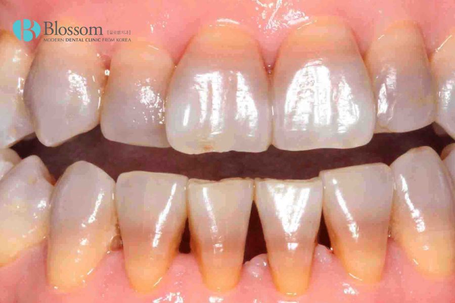 Nên dán sứ thẩm mỹ đối với trường hợp răng bị xỉn màu do nhiễm tetracyclin