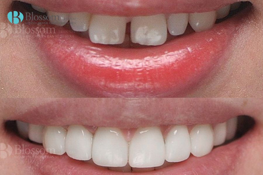 Nha Khoa Blossom - Đơn vị dán răng thưa an toàn và chất lượng với công nghệ dán sứ Lamifilm