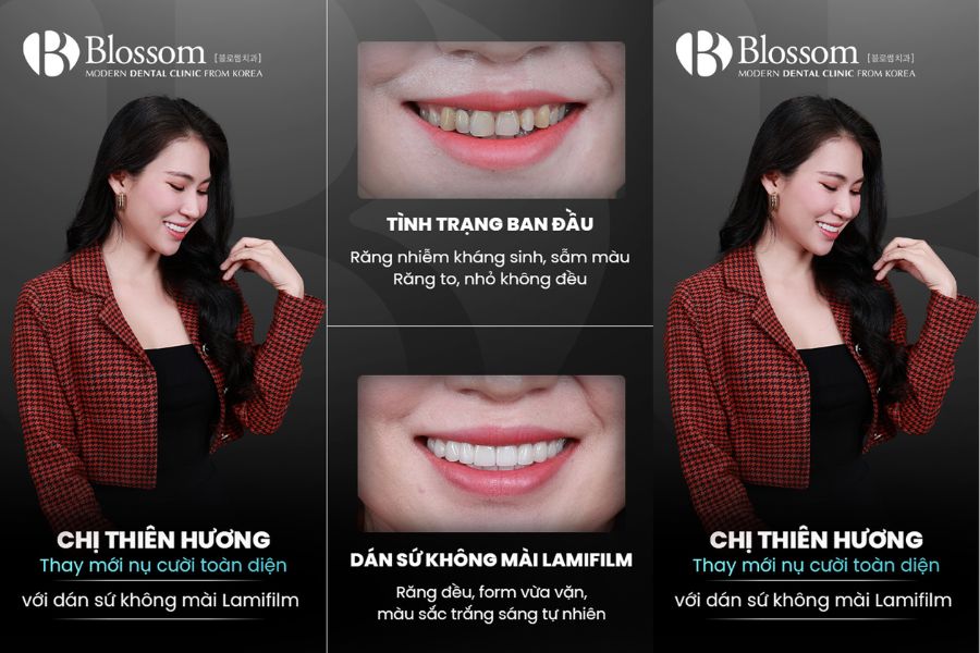 Nha Khoa Blossom là thương hiệu đi đầu trong dán phủ sứ răng với kỹ thuật Lamifilm
