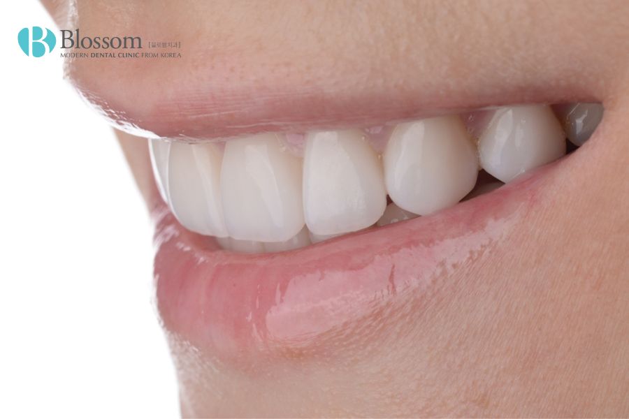 Phương pháp dán răng bằng sứ Laminate có độ bền cao và chịu lực tốt