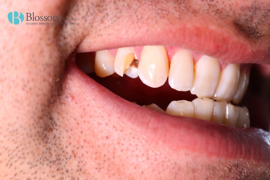 Phương pháp dán răng sứ không mài răng phù hợp với trường hợp răng bị gãy hoặc sứt mẻ nhẹ