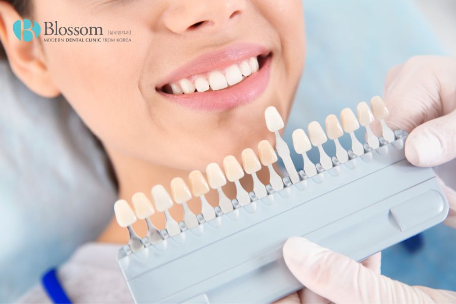 Phương pháp dán sứ nguyên hàm cho răng đảm bảo an toàn cho sức khỏe