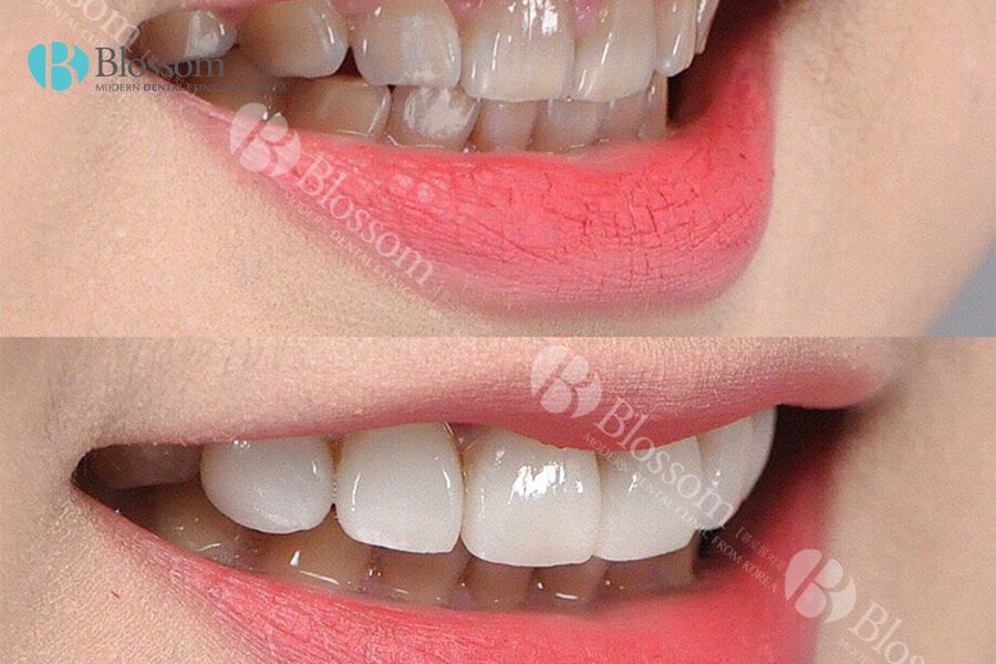 Quy trình dán răng sứ thẩm mỹ đơn giản chỉ với 5 bước thực hiện