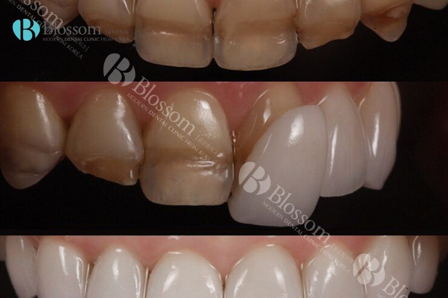 Quy trình dán sứ răng mẻ được thực hiện an toàn và nhanh chóng tại Nha Khoa Blossom