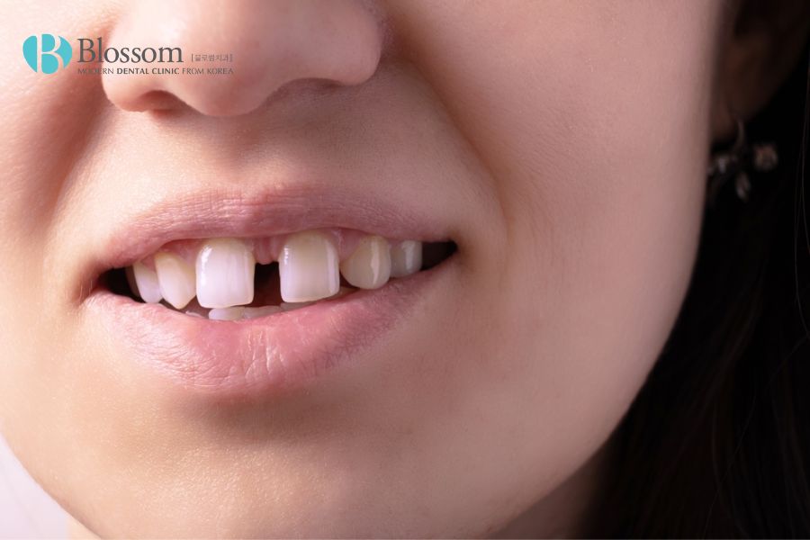 Răng có khe thưa ở 4 hoặc 6 răng cửa trước có thể thực hiện dán sứ