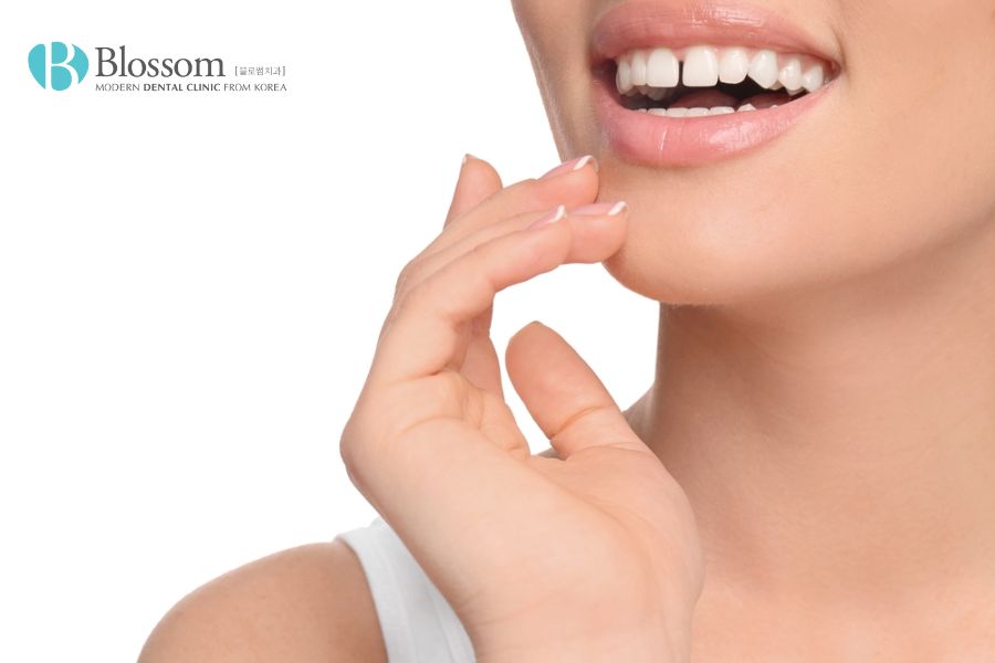 Răng cửa bị thưa nên thực hiện dán sứ để có được sự cân đối cho hàm răng
