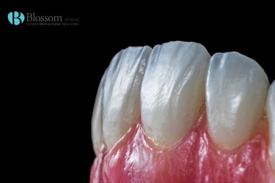 Răng toàn sứ có độ bền từ 15 - 20 năm