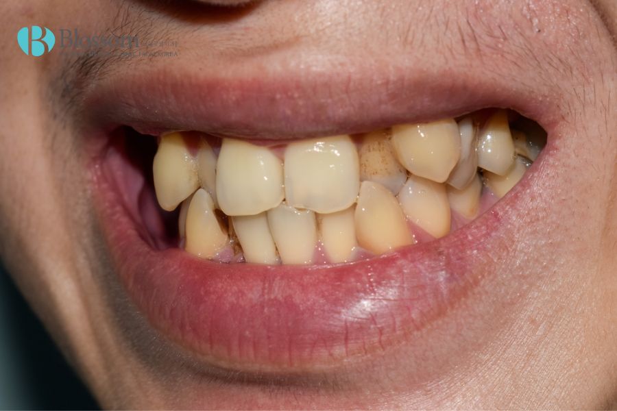Răng xỉn màu hoặc bị nhiễm kháng sinh nên áp dụng kỹ thuật dán răng sứ không mài