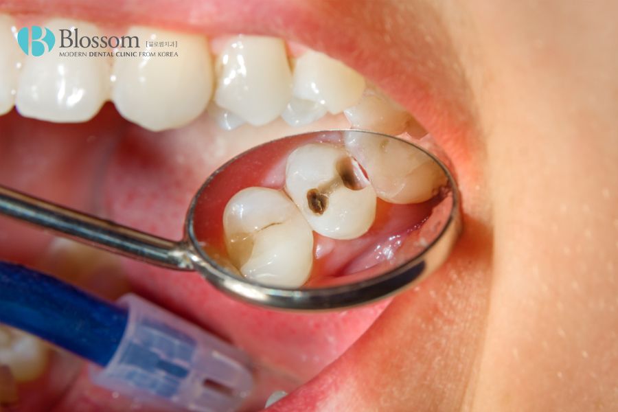 Sâu răng có thể gia tăng nguy cơ răng bị mẻ
