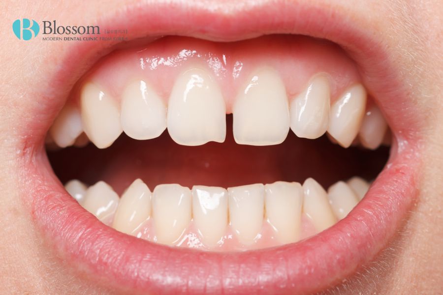 Số lượng mặt sứ cần dán cho răng thưa sẽ phụ thuộc vào sức khỏe của răng