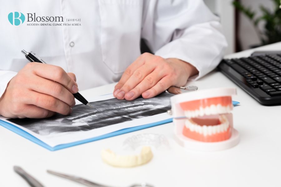 Số trụ Implant được cấy ghép cho người mất hết răng sẽ dựa trên chẩn đoán và kết luận của bác sĩ
