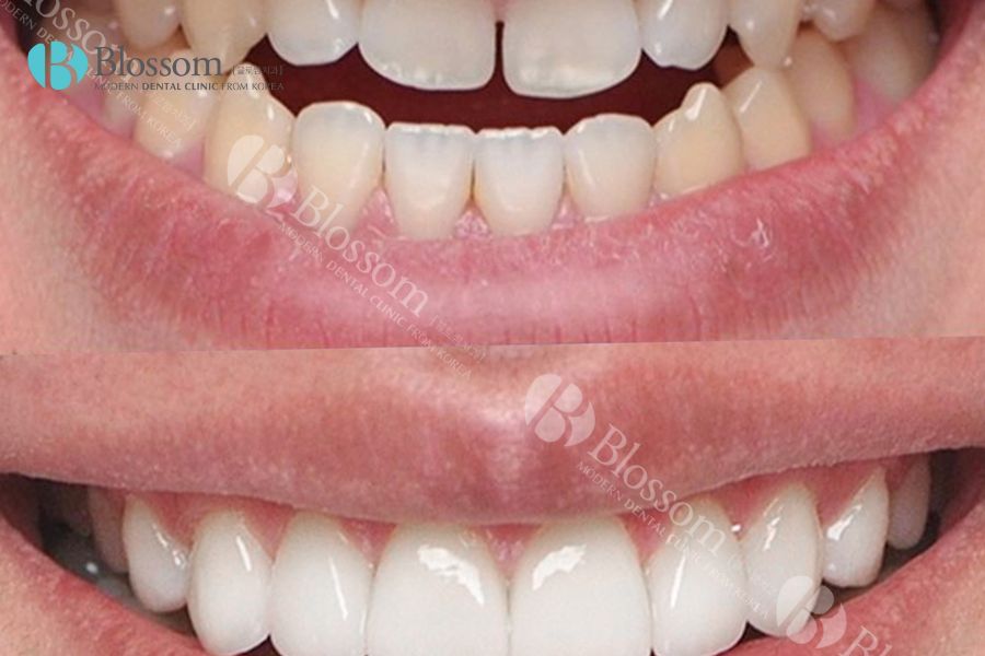 Thực hiện dán phủ sứ răng mang đến độ bền cao và tuổi thọ lâu dài cho răng