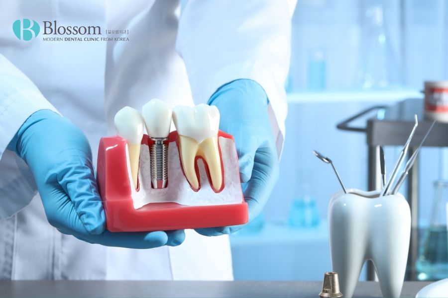 Trường hợp cần thay thế toàn bộ các răng có thể thực hiện phương pháp cấy ghép Implant
