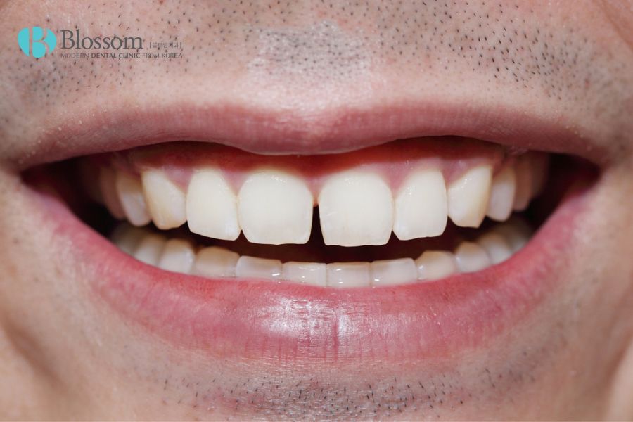Trường hợp răng thưa bị sâu nhẹ thì nên dán sứ thay cho phương pháp bọc răng sứ