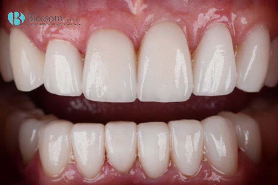 Tùy phương pháp chế tác cũng như chất liệu sứ mà tạo răng sứ nguyên hàm có màu sắc, hình dạng khác nhau