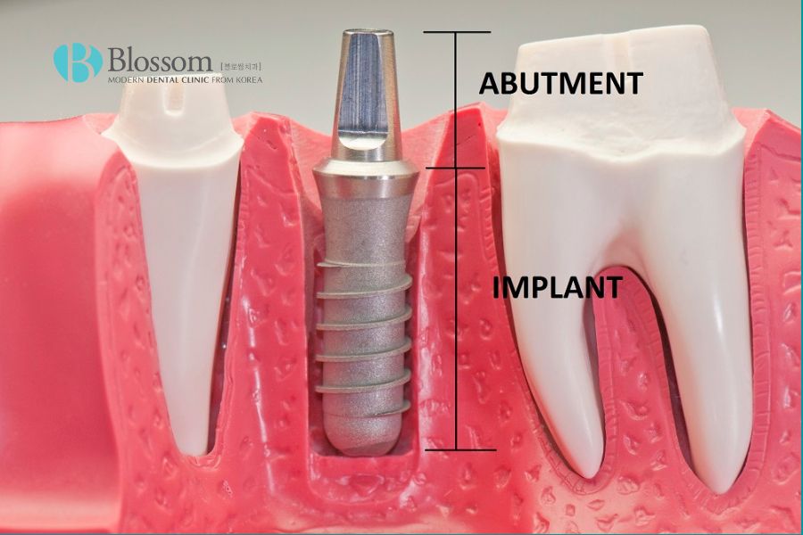 Abutment Implant là một phần quan trọng tạo ra chiếc răng giả implant hoàn chỉnh.