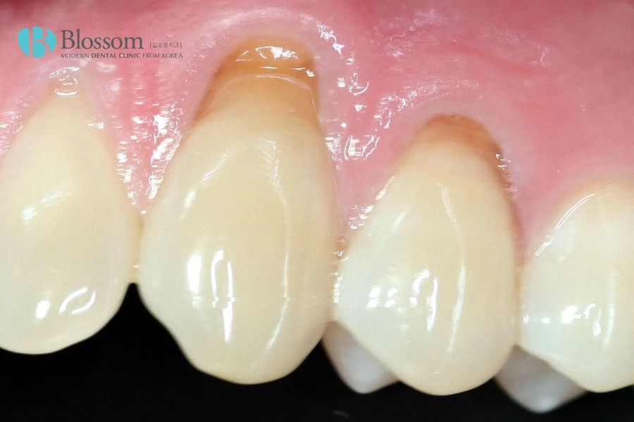 Bệnh mòn cổ chân răng rất thường gặp trong nha khoa.