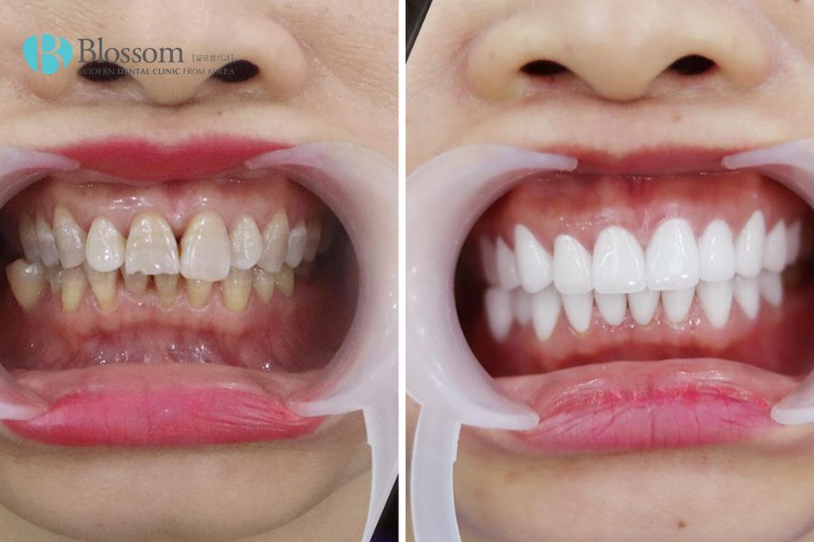 Bọc răng sứ áp dụng với tình trạng răng hô nhẹ.