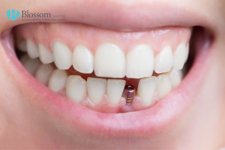 Cần chọn thời điểm trồng răng Implant thích hợp để tránh thêm chi phí ghép xương