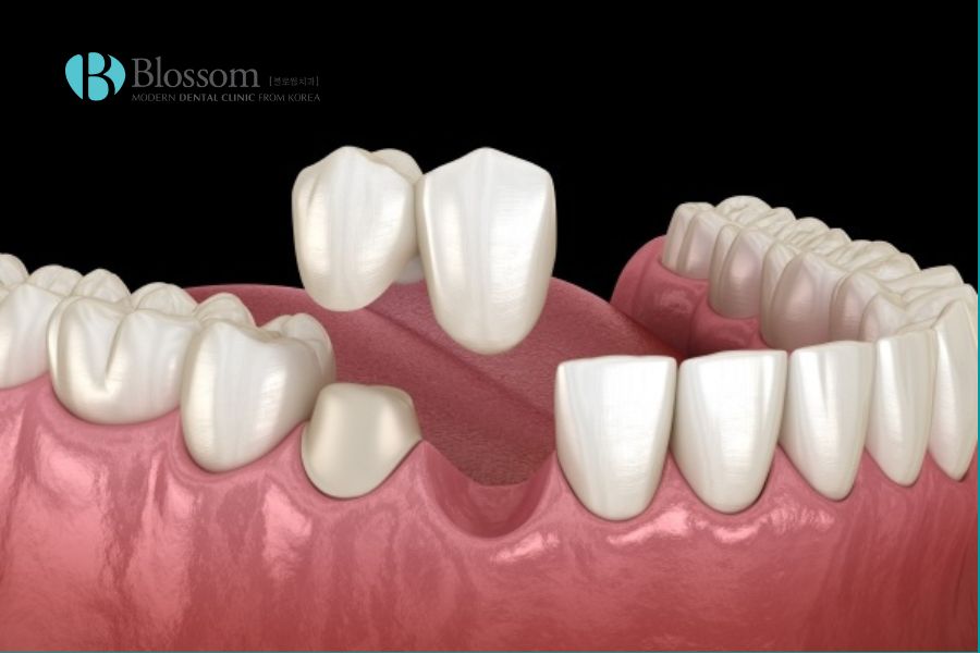 Cầu răng sứ nhảy thích hợp cho vùng răng cửa hoặc một bên răng.