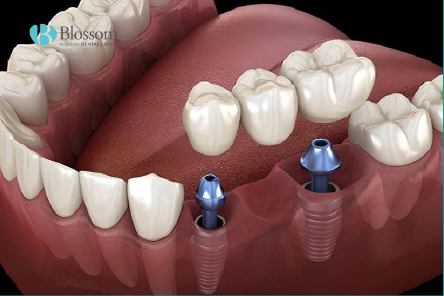 Cầu răng sứ trên trụ Implant là giải pháp tối ưu cho nụ cười hoàn chỉnh.