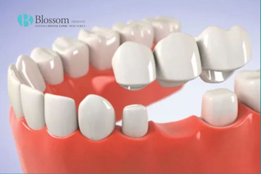 Cầu răng sứ truyền thống là phương pháp phục hình răng phổ biến nhất hiện nay.