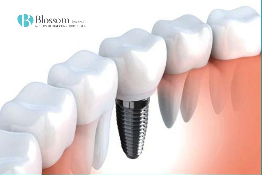 Cấu trúc răng implant vững chắc và ổn định.