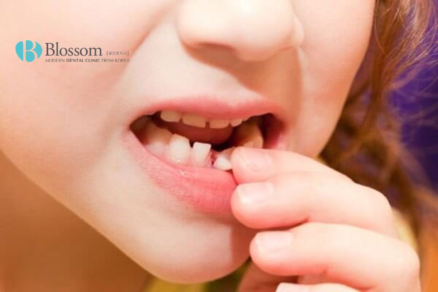 Chấn thương răng rất dễ dẫn đến tình trạng đau nhức.
