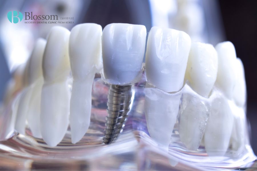 Chất liệu răng sứ sẽ ảnh hưởng đến tổng chi phí khi thực hiện cấy ghép Implant